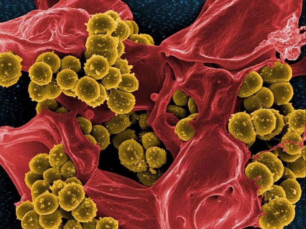 MRSA Infection