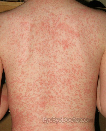 Fungal Rash On Chest - Doctor answers on HealthTap