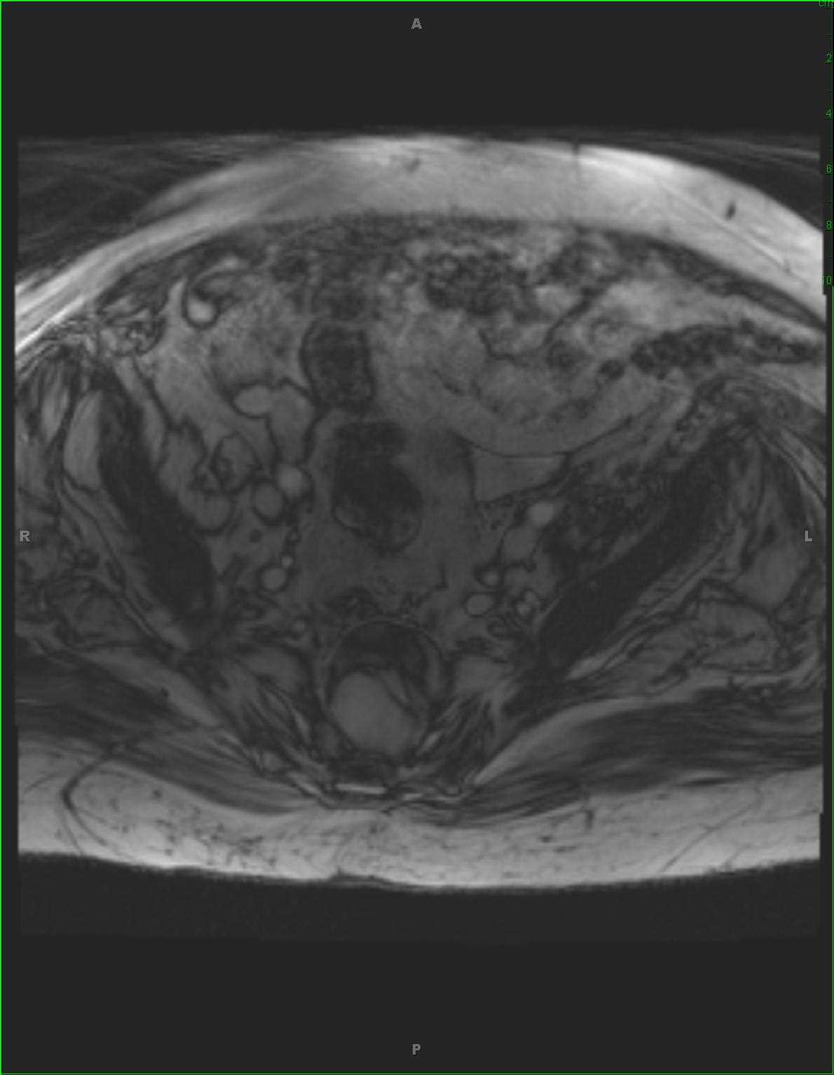 Pre-sacral Liposarcoma - CTisus CT Scan