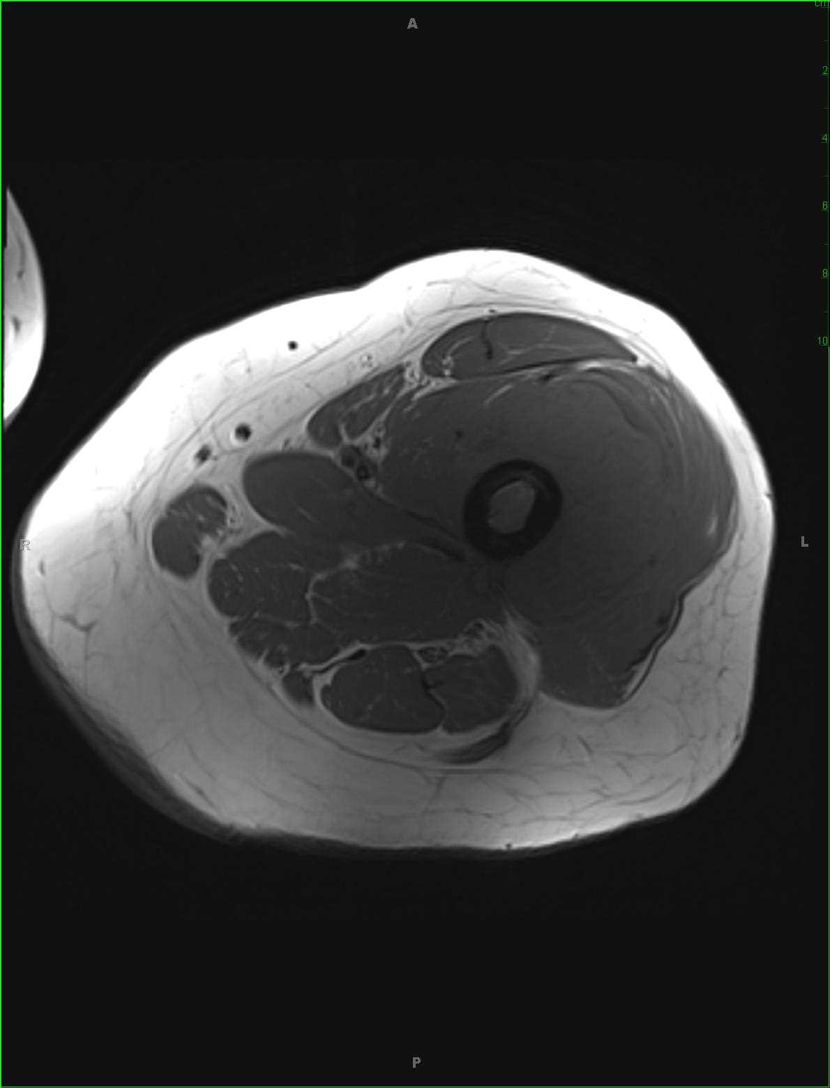 Ewing Sarcoma, Femur - CTisus CT Scan