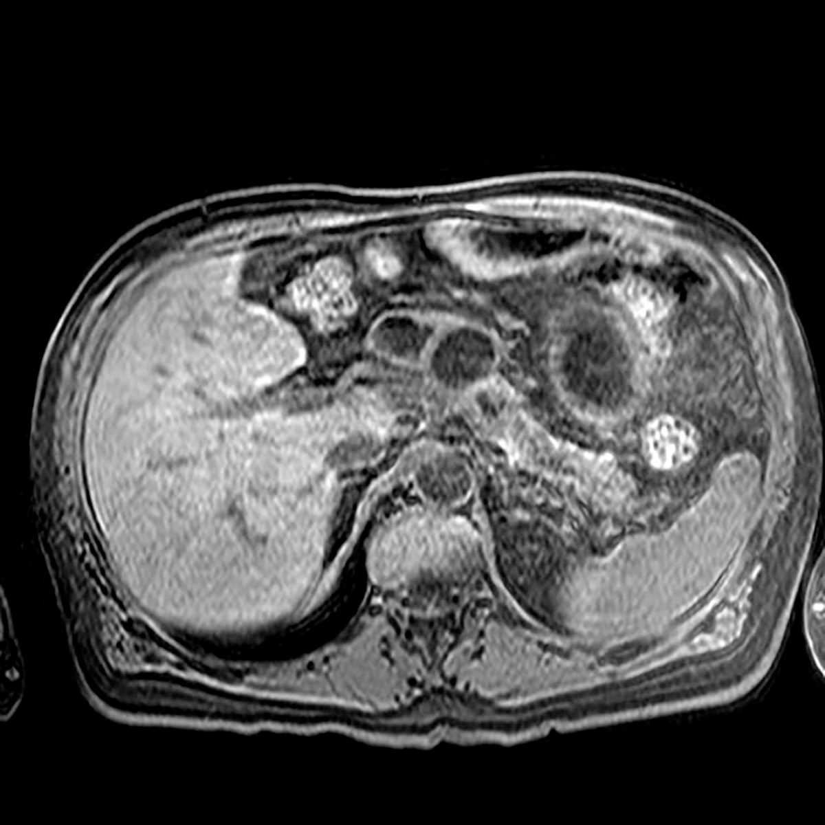 Chronic pancreatitis - CTisus CT Scan