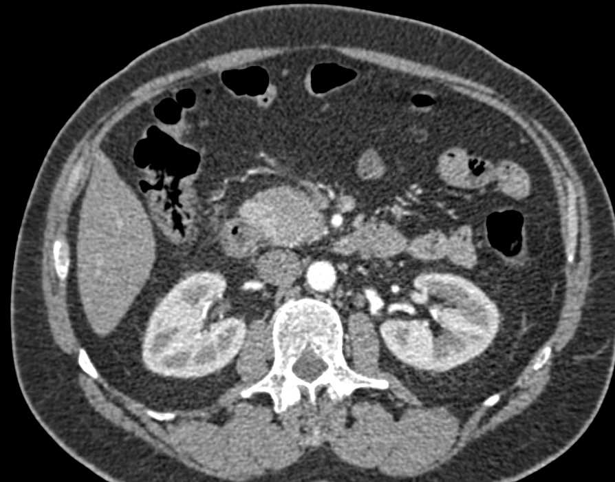 Carcinoma of the Head of the Pancreas - CTisus CT Scan