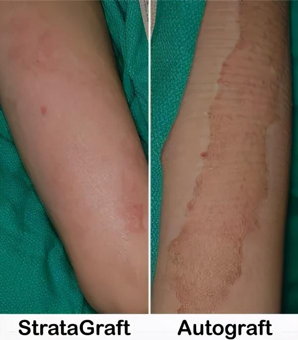 List 99+ Pictures burn skin graft before and after pictures Stunning