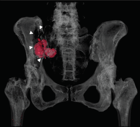 Top Tips in Interventional Oncology - Endovascular Today image.