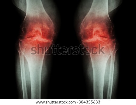 Osteoarthritis Knee ( OA Knee ) ( Film x-ray both knee with arthritis of knee joint : narrow knee joint space ) ( Medical and Science background )