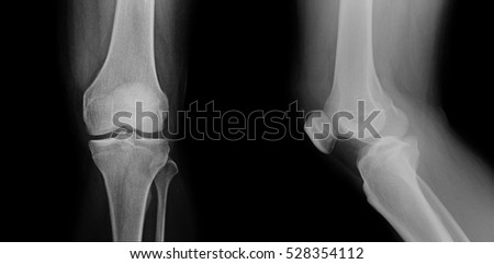 X-ray image of normal old age Knee