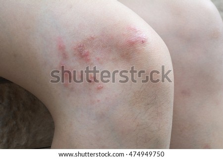 Close-up eczema atopic dermatitis symptom with infected skin on child, kid knee.Patient with Psoriasis