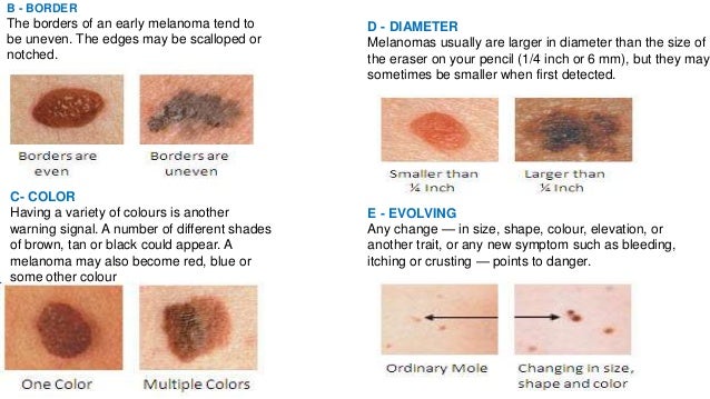 melanoma on scalp pictures #10