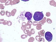 “Flaming” promyelocyte - 1.