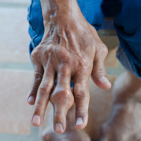 Fingers of patients with gout.