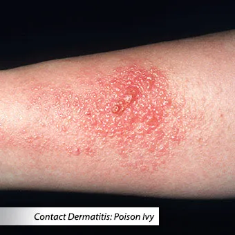 Fungal Skin Infection Treatment - Aidance Skincare