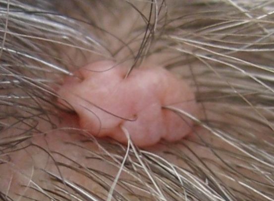 melanoma on scalp pictures #11