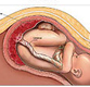 pregnancy-placenta-cord