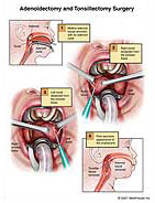 adenoidectomy-tonsillectomy-surgery