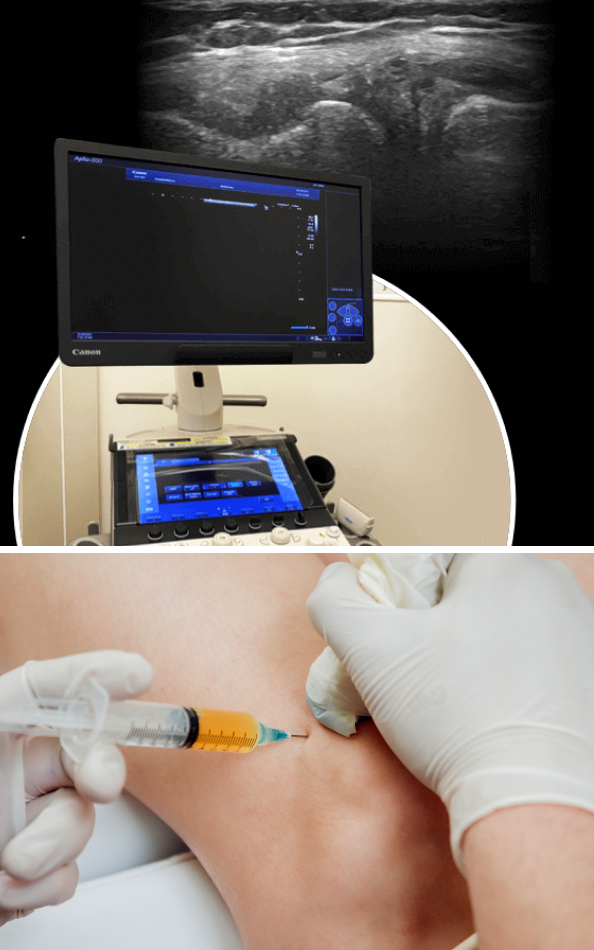 Why Ultrasound is Superior to MRI for Diagnosing Meniscus Tears