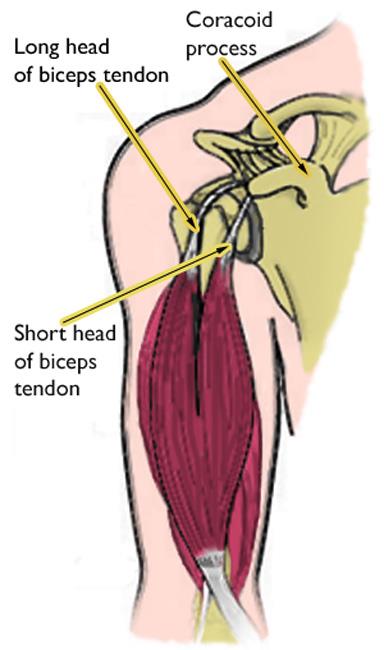 Biceps tendons