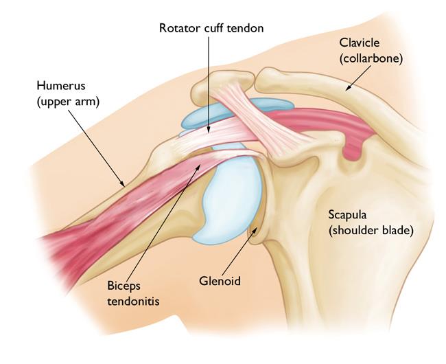 Biceps tendinitis 