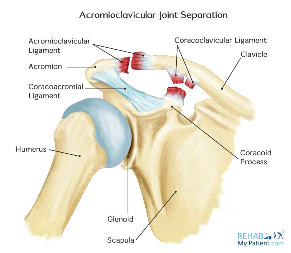 Acromioclavicular Joint Separation