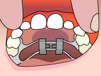 Palatal expander illustration