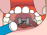 Palatal expander illustration