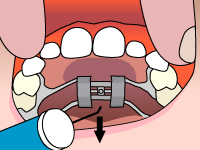 Palatal expander illustration