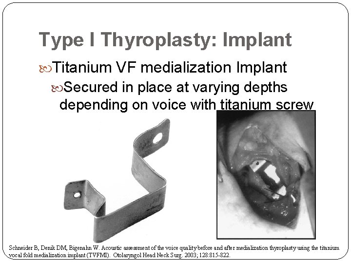 Type I Thyroplasty: Implant Titanium VF medialization Implant Secured in place at varying depths