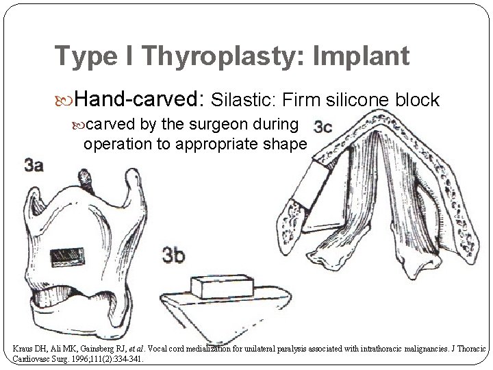 Type I Thyroplasty: Implant Hand-carved: Silastic: Firm silicone block carved by the surgeon during