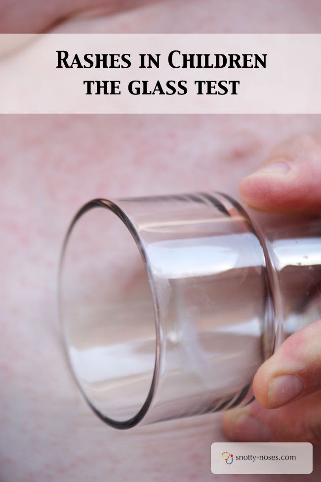 The Glass Test. How to tell if a rash is a non-blanching rash or a blanching rash.