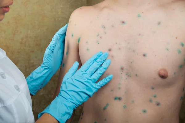 Chickenpox. Skin rash. Viral disease.