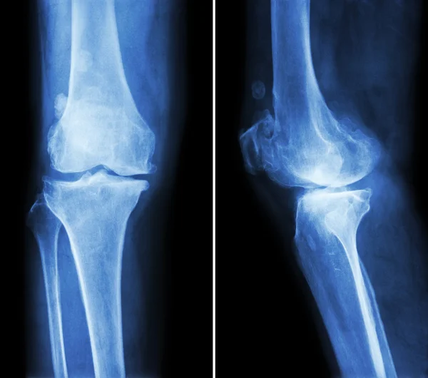 Osteoarthritis knee .  film x-ray knee ( anterior - posterior and lateral view )  show narrow joint space , osteophyte ( spur ) , subcondral sclerosis due to degenerative change