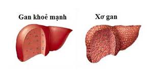 NHỮNG BIỂU HIỆN CỦA BỆNH GAN MÀ MỌI NGƯỜI CẦN BIẾT