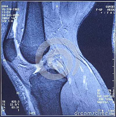 My knee MRI - damage of cross-shaped ligaments