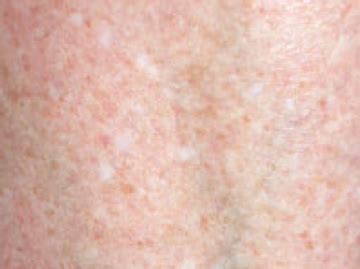 Skin Cancer Discoloration