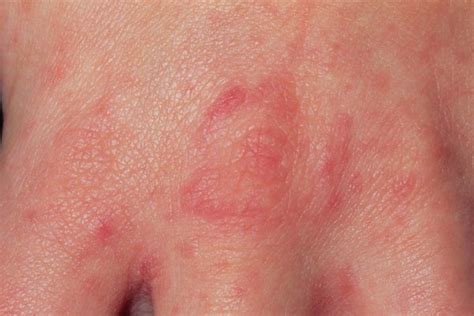 Scabies Symptoms Causes Treatment Preventions - Symptom Clinic