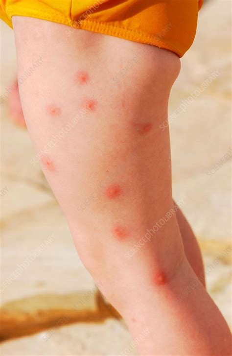 Mosquito bites - Stock Image - C030/9611 - Science Photo Library