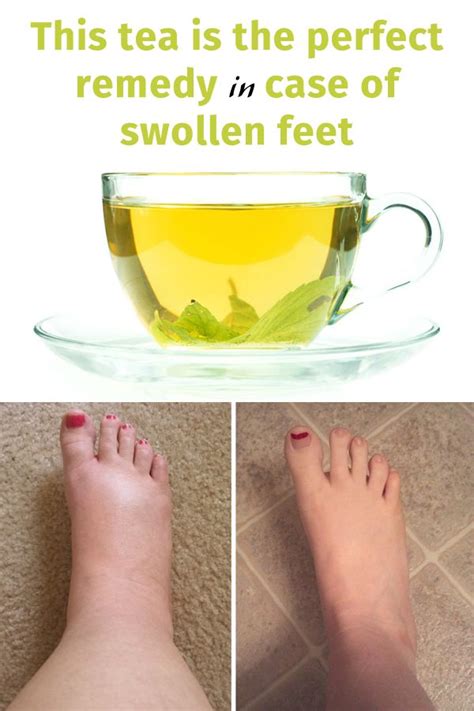 swollen feet after delivery symptoms - Sena Conley