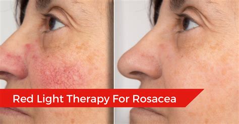 Red Light Therapy For Rosacea: Is This Light-Based Therapy Effective ...