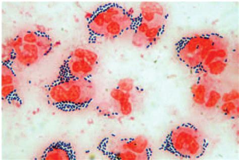 Neisseria Meningitis Gram Stain