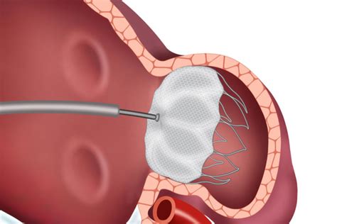 Improving Heart Patients’ Lives with Left Atrial Appendage (LAA ...