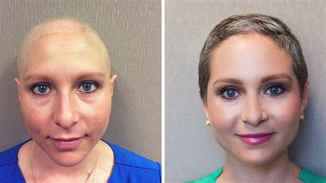 Chemo Hair Loss Eyebrows : Chemo Patient Says Eyebrow Gel Helped Her ...