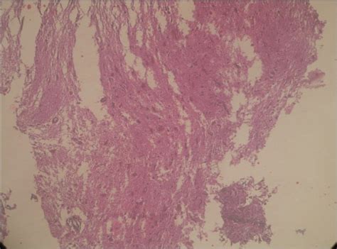 Brain metastasis from papillary carcinoma of thyroid gland - Journal of ...