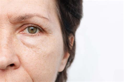 Puffy Eyes: Causes and Remedies