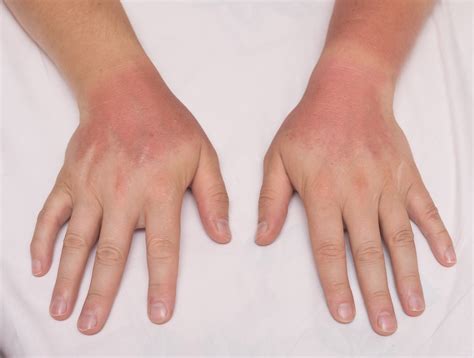 Rheumatoid Arthritis Medications & Sun Exposure - Rheumatology Advisor