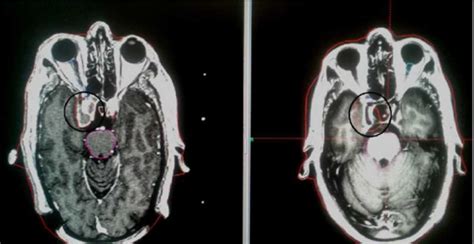 (b): A case of prolactinoma, before and after treatment; tumor size ...