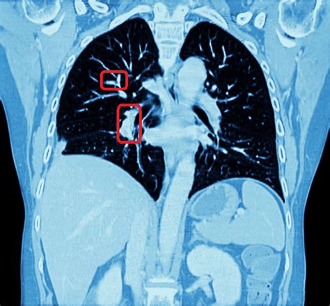 Automated Chest CT Scan Analysis with Deep Learning Classifier