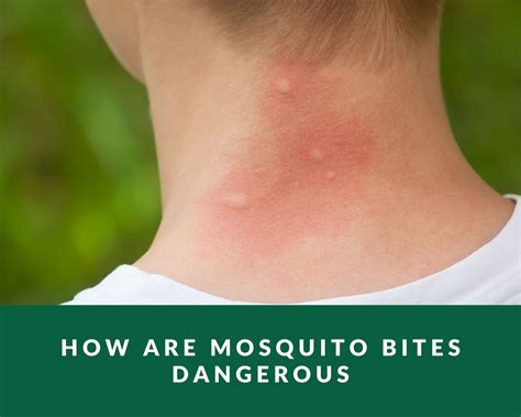 How are mosquito bites dangerous - Zero Pest NG