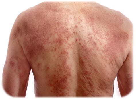 Atopic Dermatitis - UNION Therapeutics