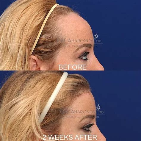 Hairline Lowering Surgery | Plastic Surgery