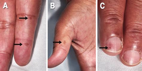 A and B Janeway lesions, C splinter haemorrhages. | Download Scientific ...