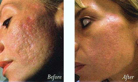 Laser Treatment of Acne Scars